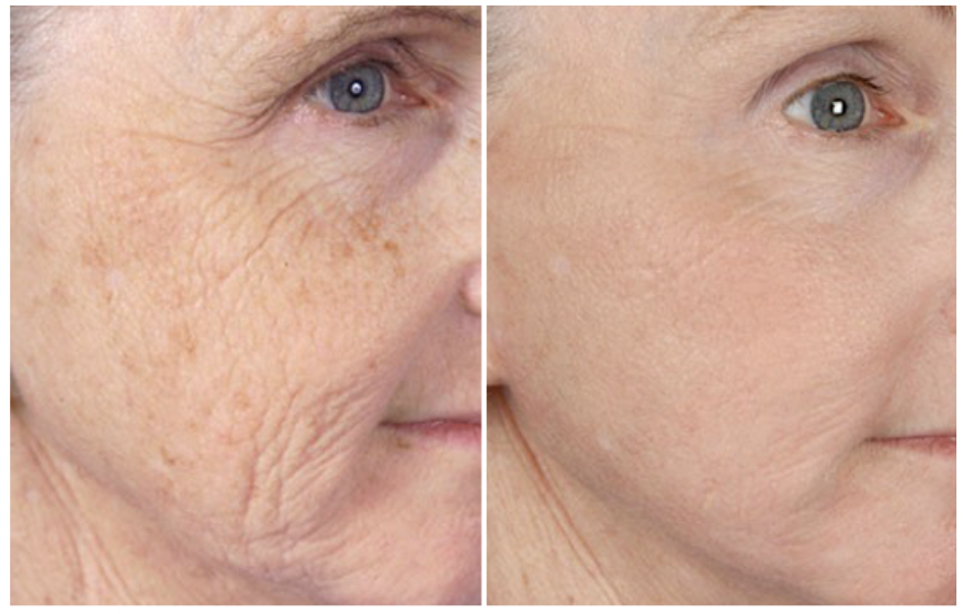 Exion™ RF Microneedling before and after — Fine Lines & Wrinkles
